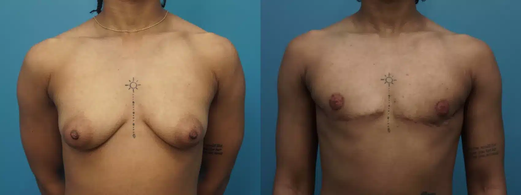 Before and After Image: Case #439 - front