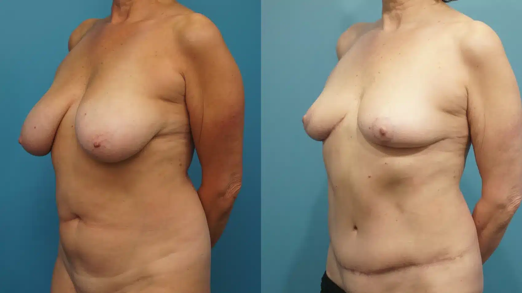 Before and After Image: Breast Lift with Tummy Tuck