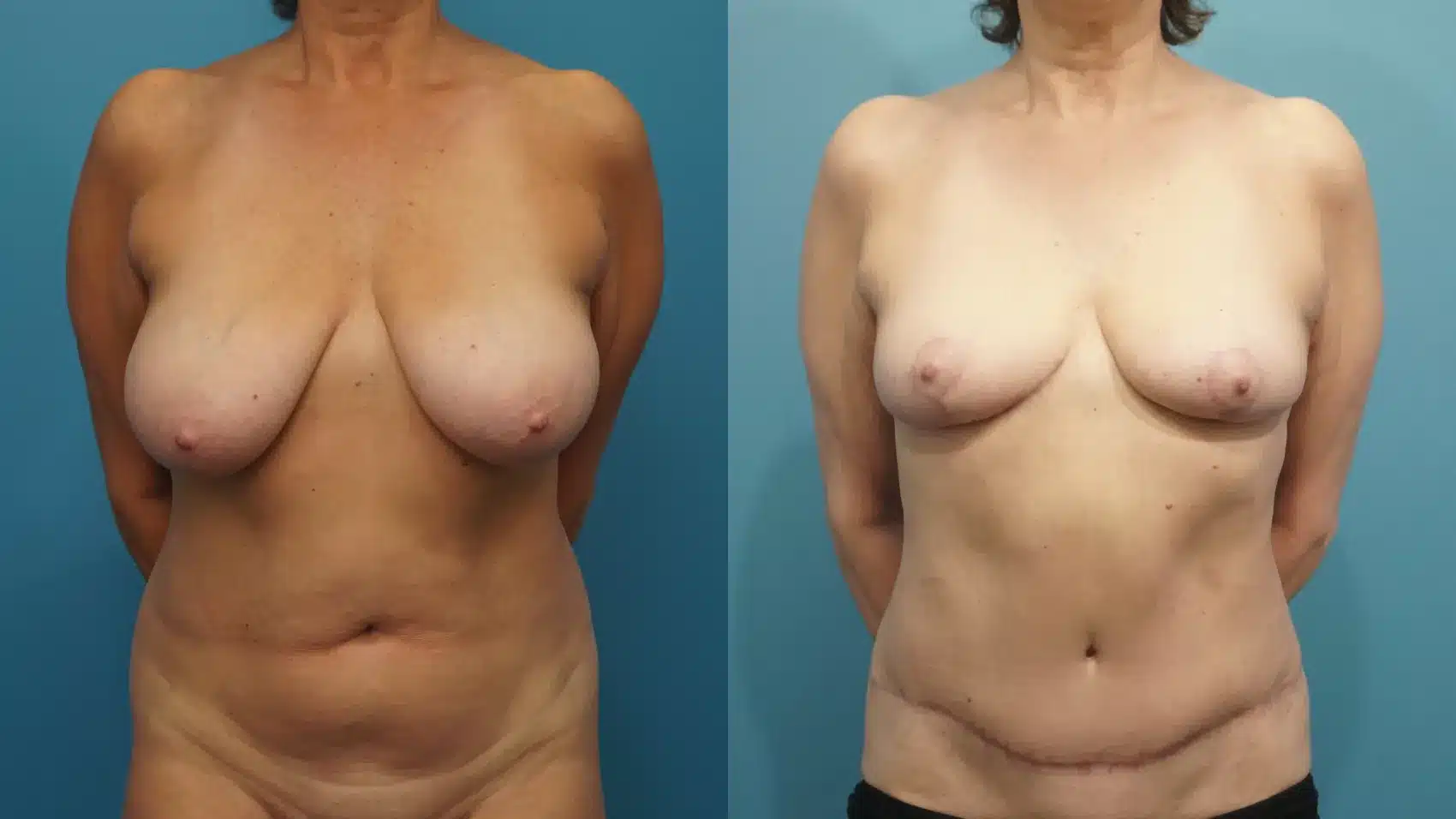 Before and After Image: Breast Lift with Tummy Tuck - front