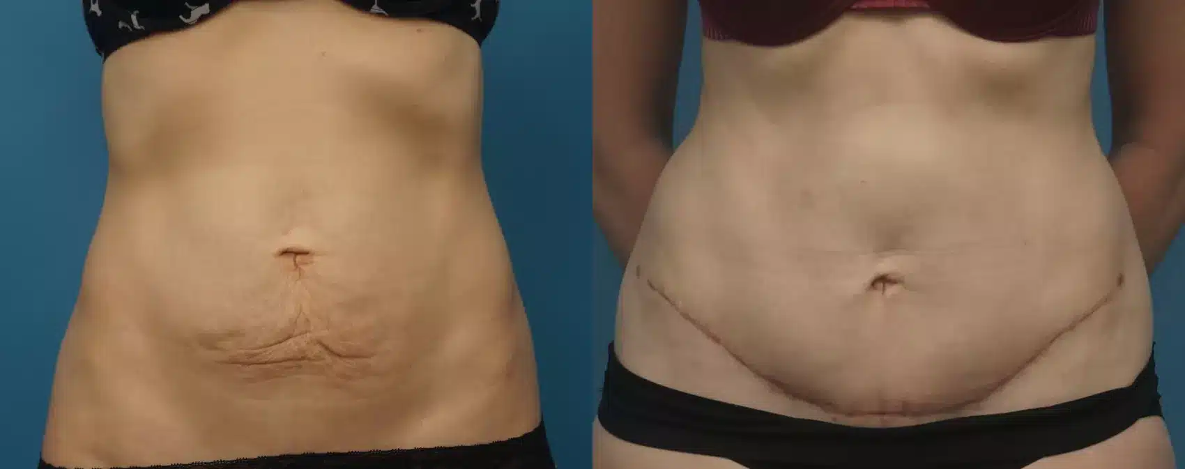 Before and After Image: Case #441 - front