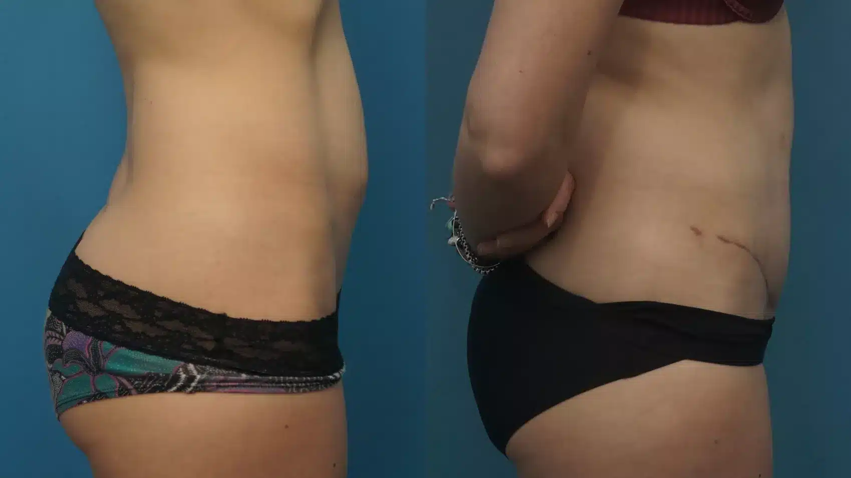 Before and After Image: Case #441 - right-side