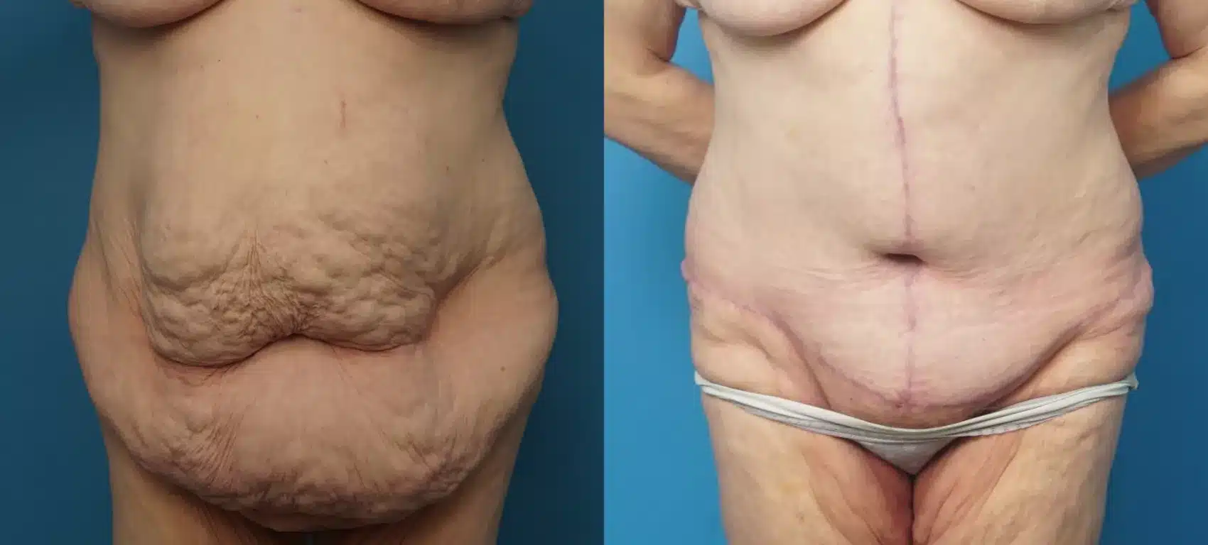 Before and After Image: Case #442 - front