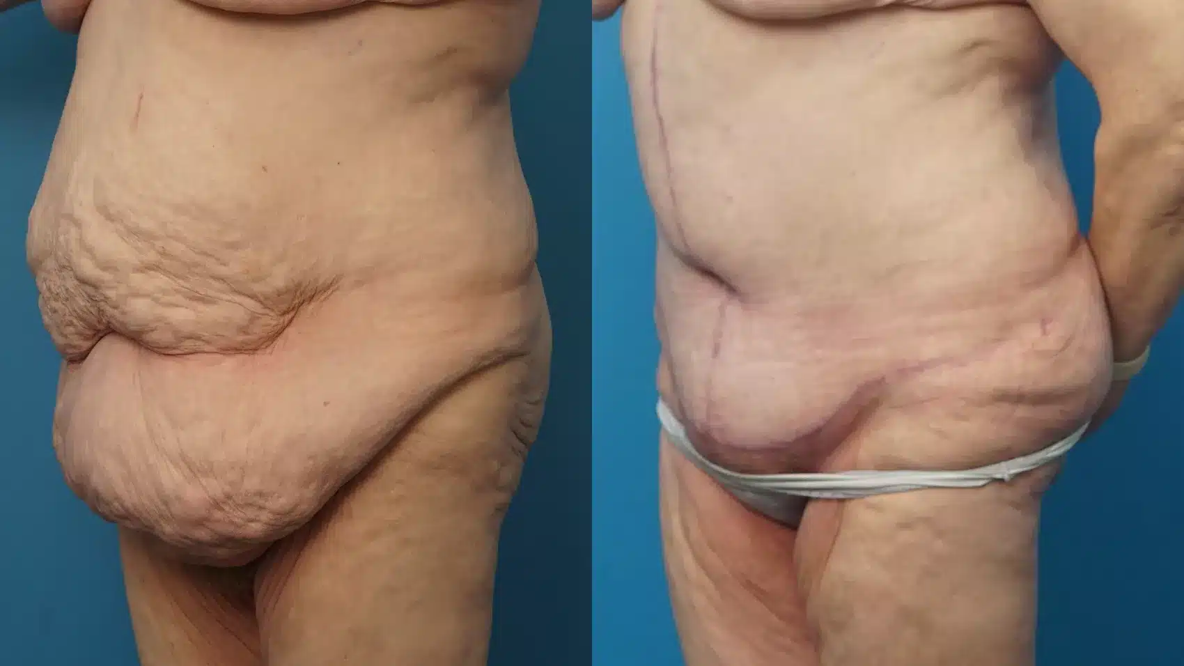 Before and After Image: Case #442 - left-front-oblique