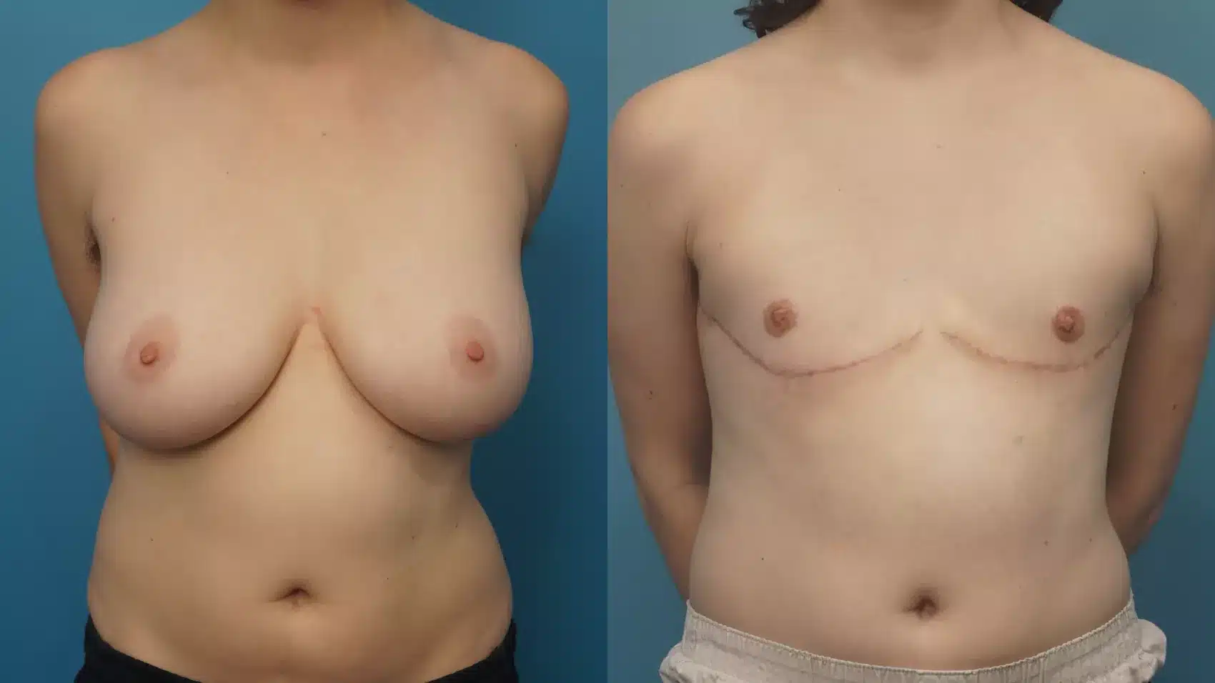 Before and After Image: Case #443 - front