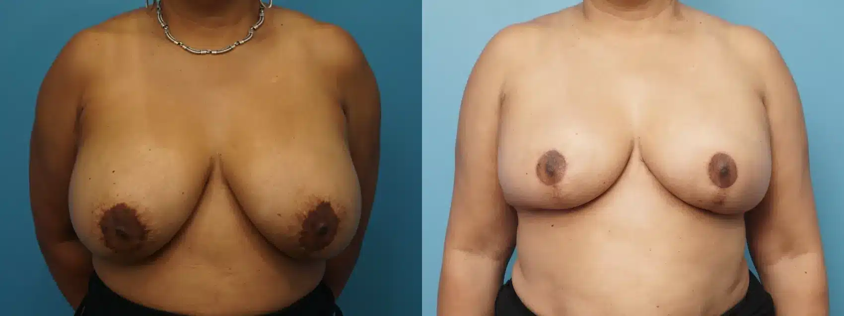Before and After Image: Breast Implant Removal with Oncoplastic Reconstruction - front