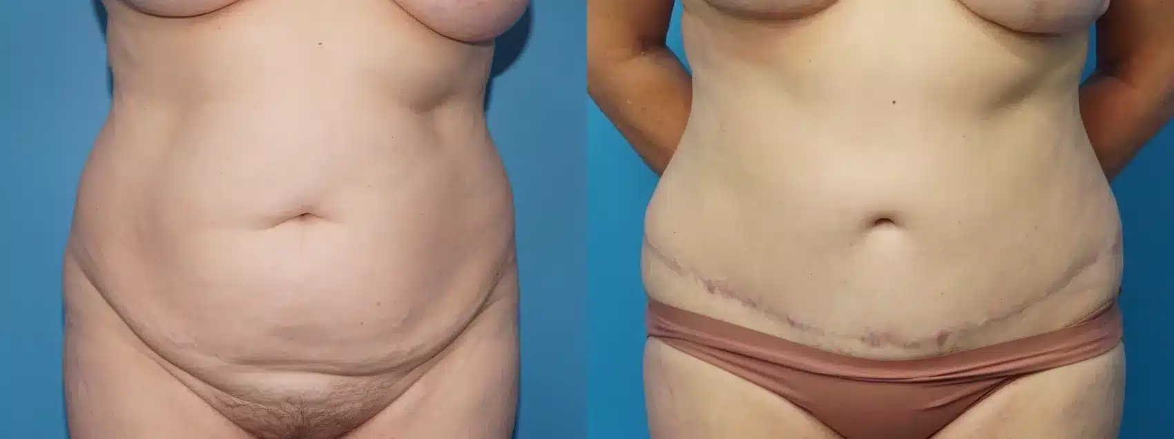 Before and After Image: Case #445 - front