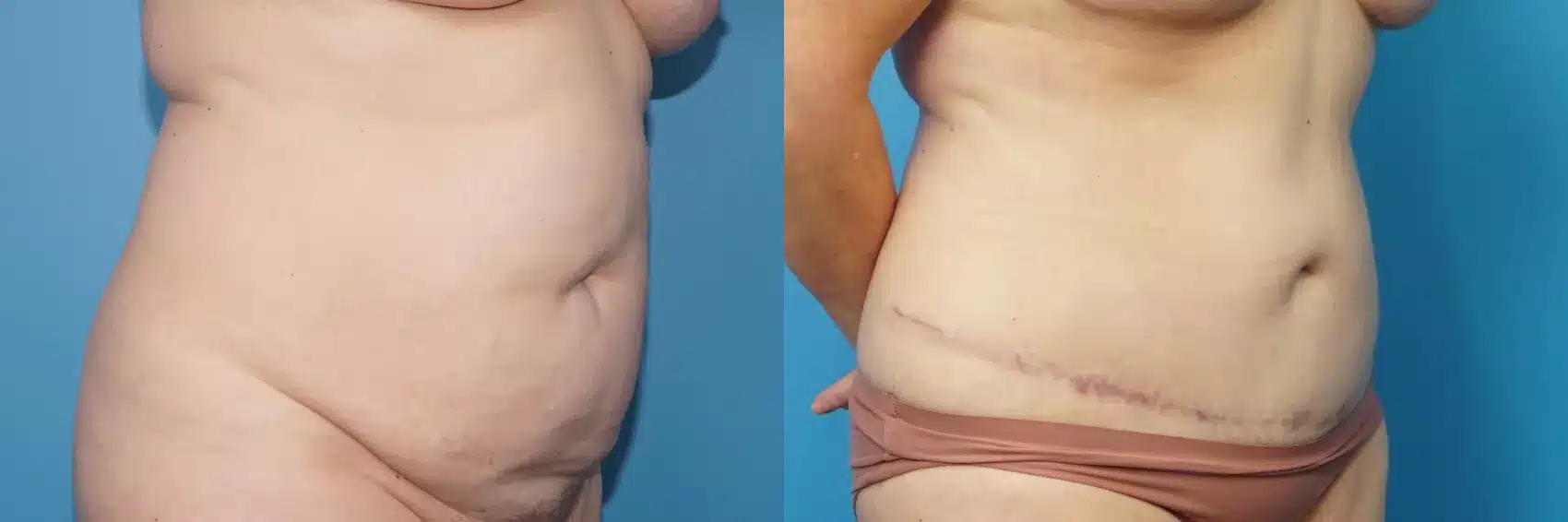 Before and After Image: Case #445 - right-front-oblique