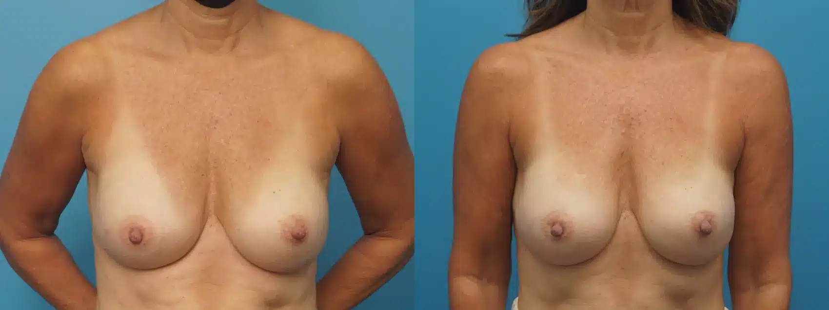 Before and After Image: Case #447 - front