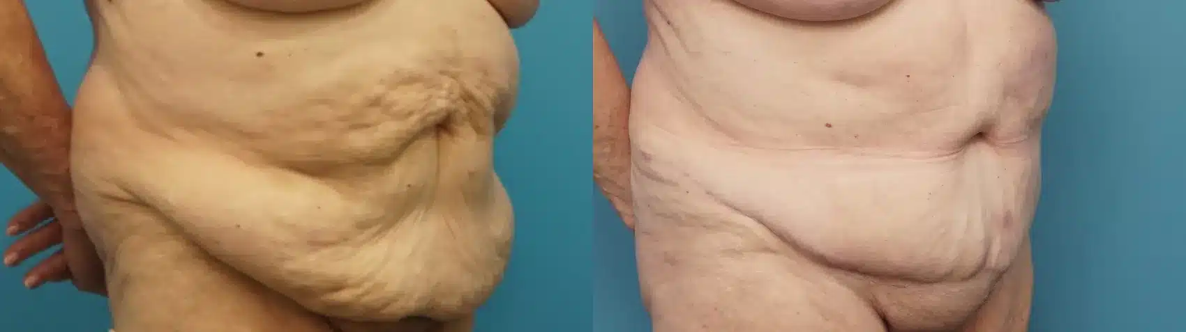 Before and After Image: 70 Year Old Tummy Tuck with Liposuction - right-front-oblique