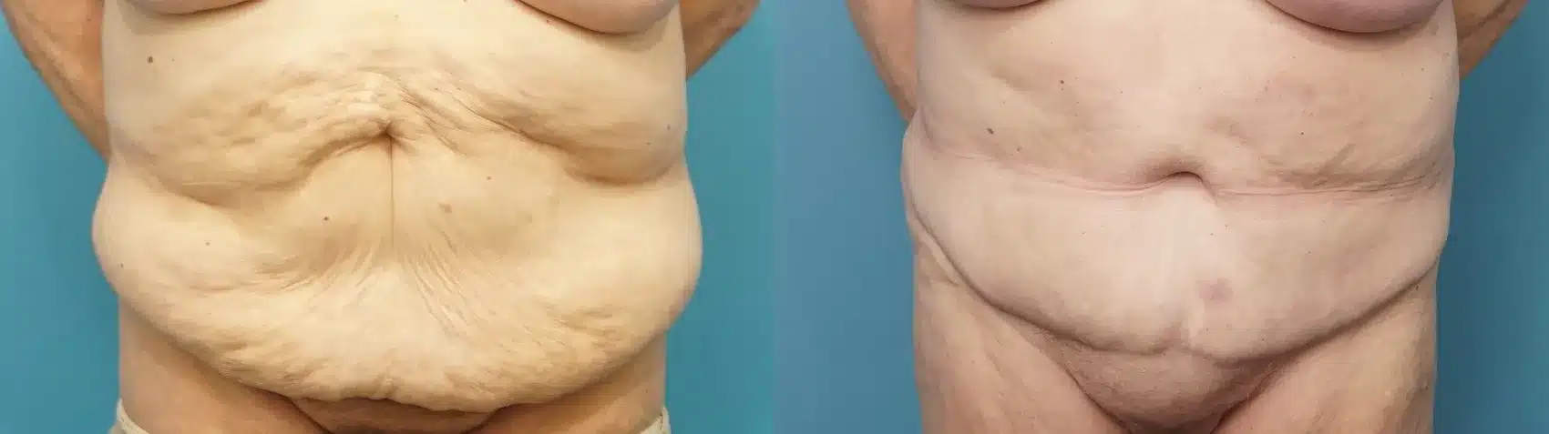 Before and After Image: 70 Year Old Tummy Tuck with Liposuction - front