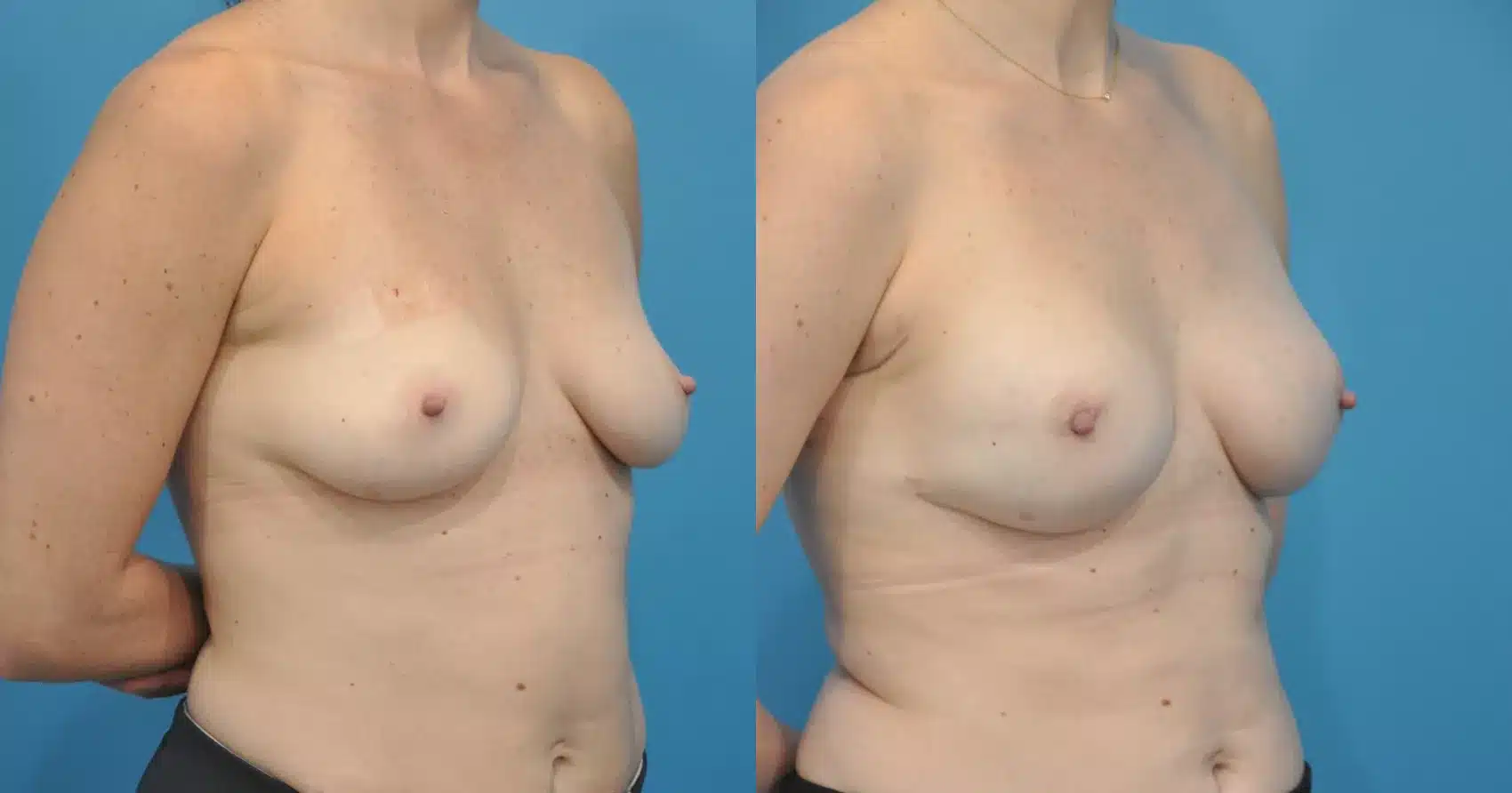 Before and After Image: Case #45 - right-front-oblique
