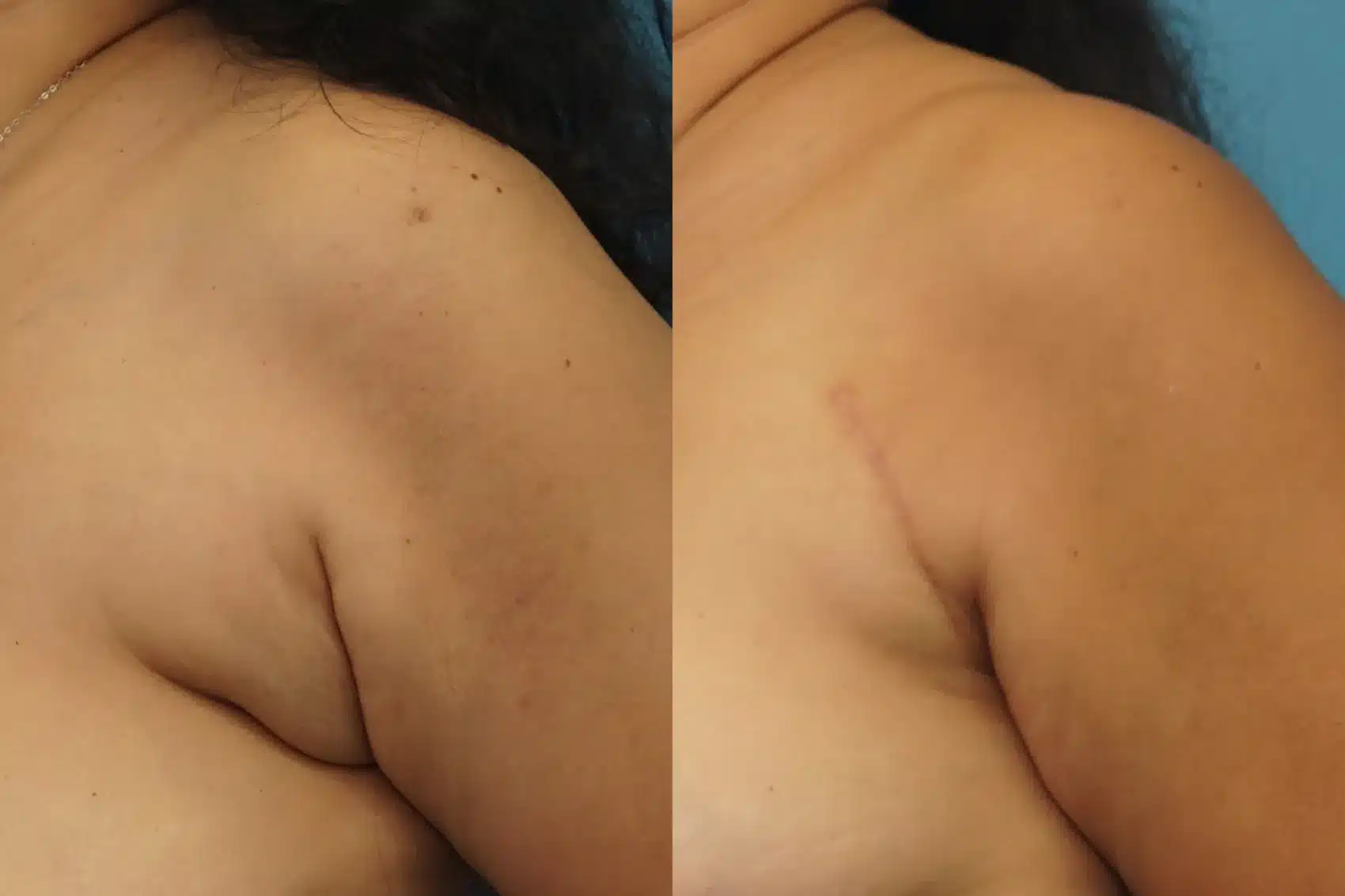 Before and After Image: Axillary Breast Tissue Removal - left-front-oblique