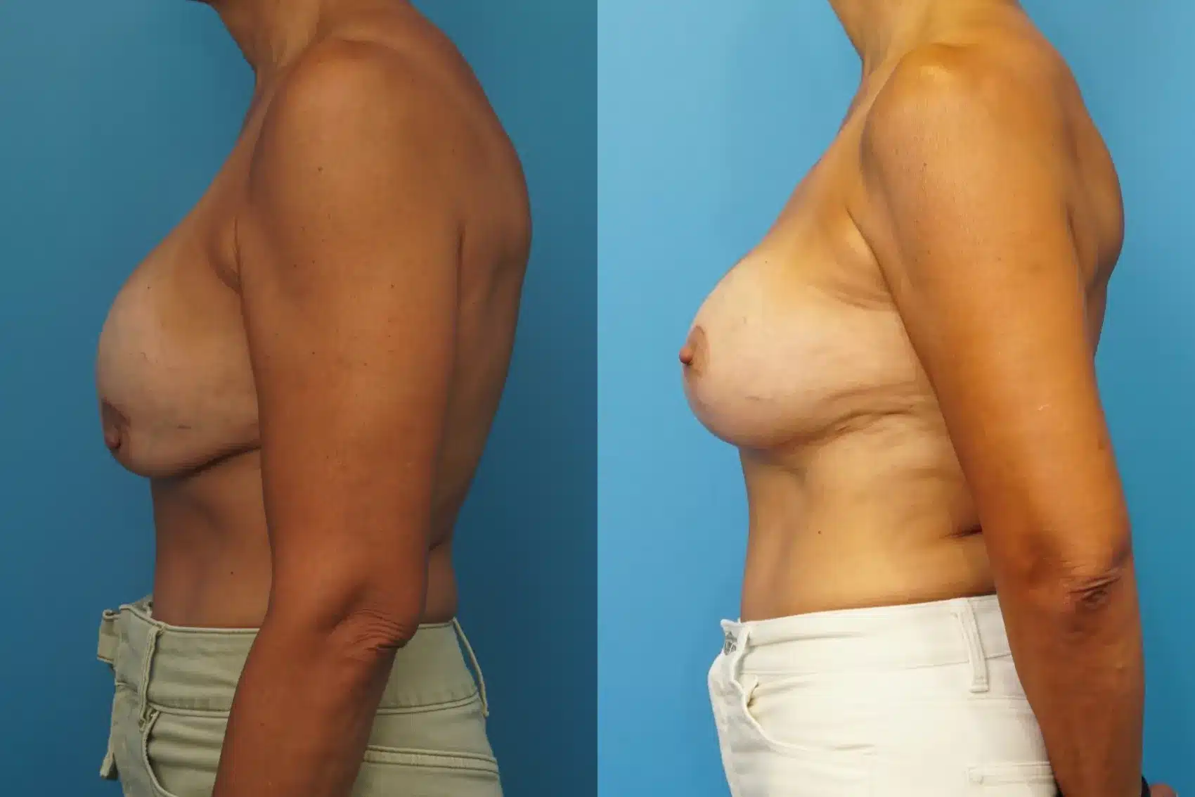 Before and After Image: Revision Breast Augmentation with Lift