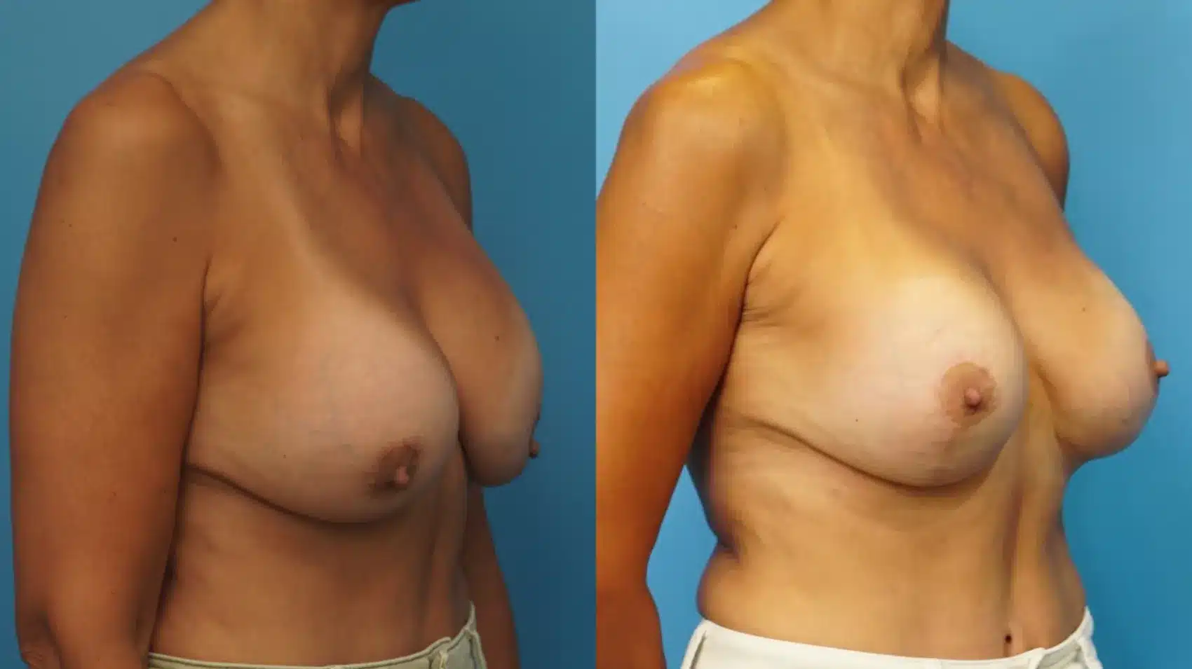 Before and After Image: Revision Breast Augmentation with Lift - right-front-oblique