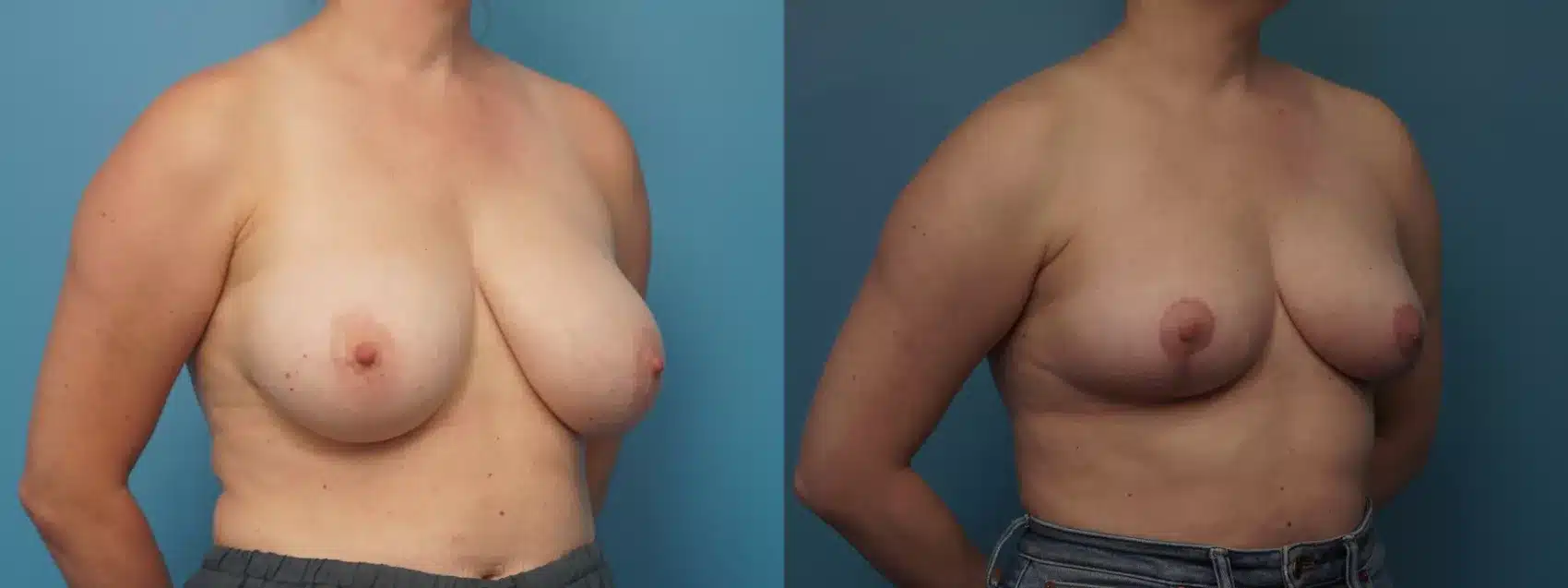 Before and After Image: Case #452 - right-front-oblique