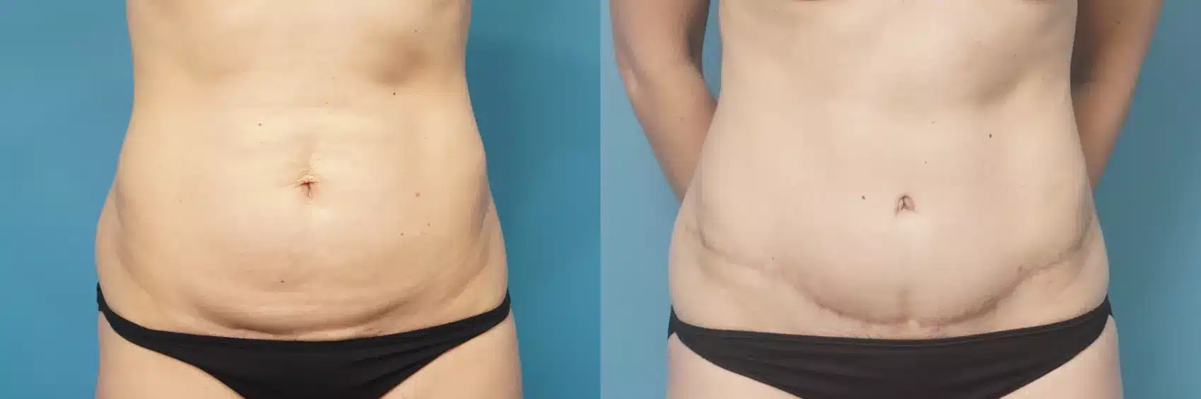 Before and After Image: Case #454 - front