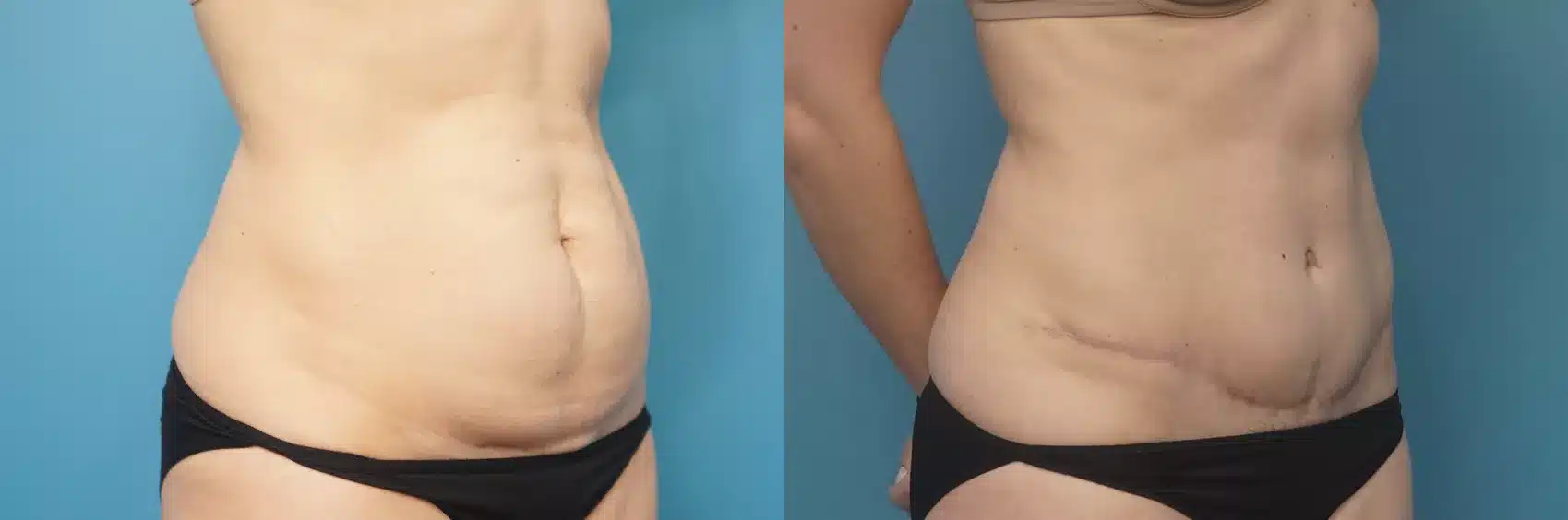 Before and After Image: Case #454 - right-front-oblique