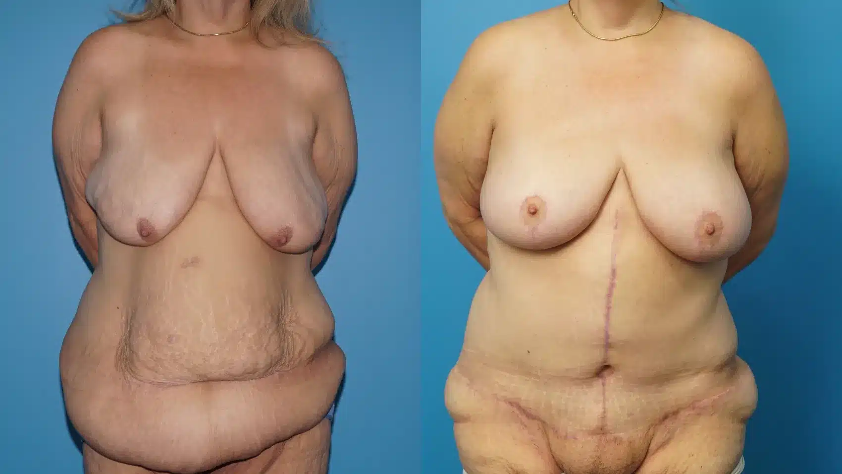 Before and After Image: Fleur de Lis Abdominoplasty and Breast Lift - front