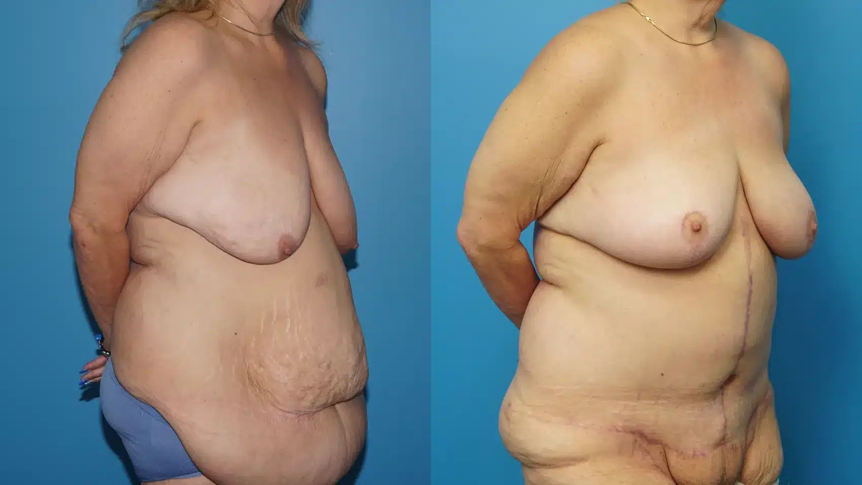 Before and After Image: Fleur de Lis Abdominoplasty and Breast Lift - right-front-oblique