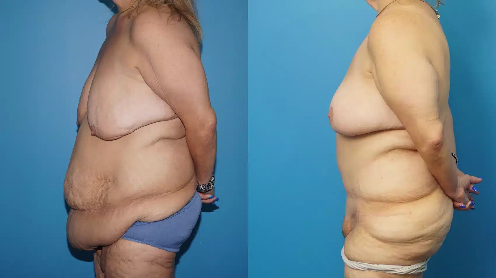 Before and After Image: Case #457 - left-side