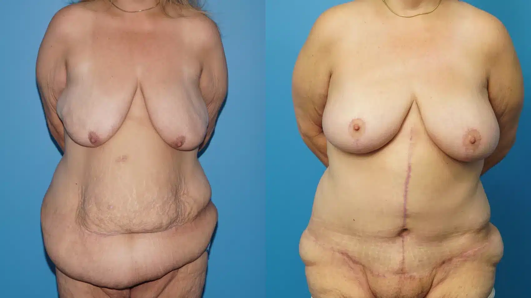 Before and After Image: Case #457 - front