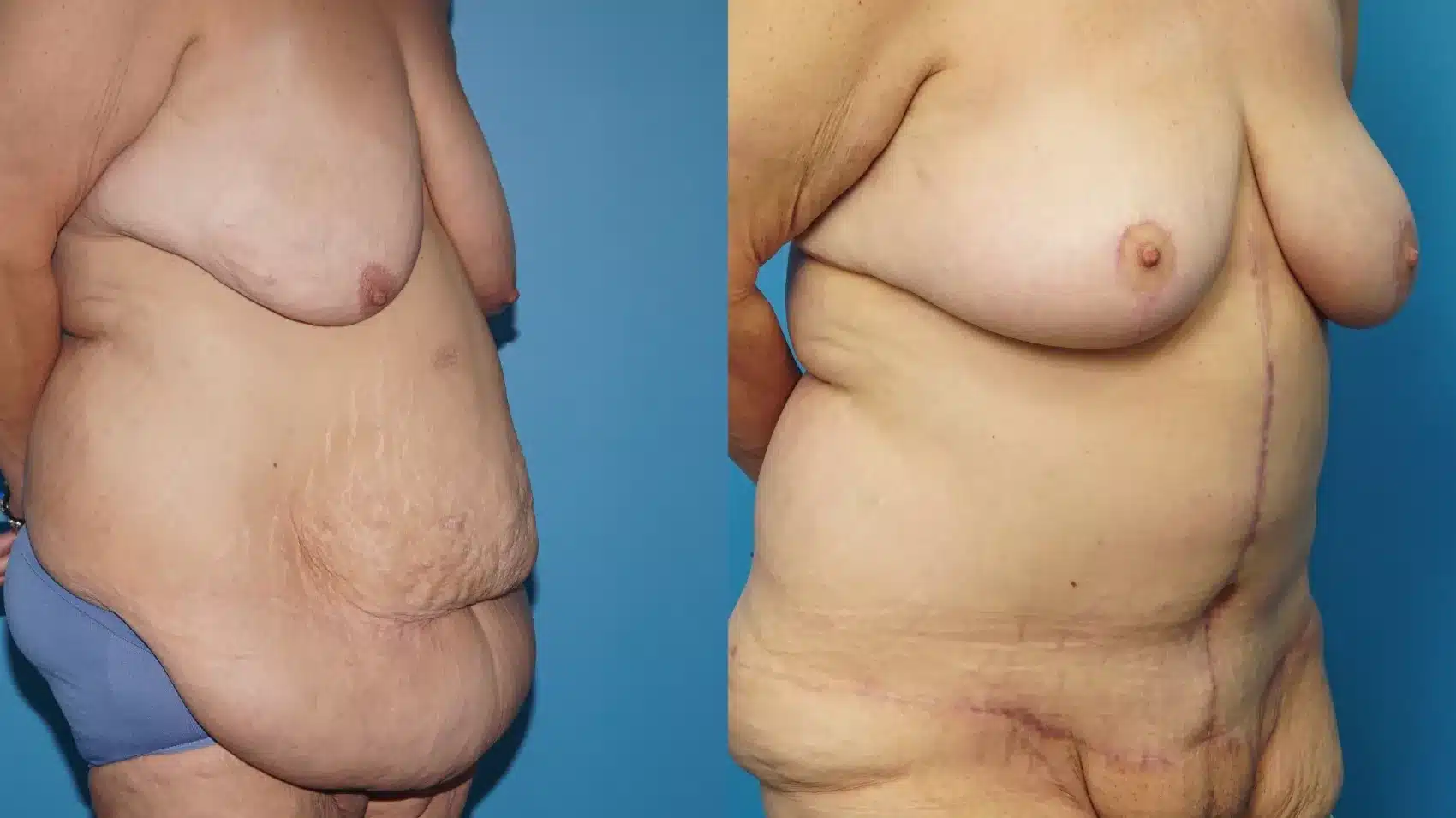 Before and After Image: Case #457 - right-front-oblique