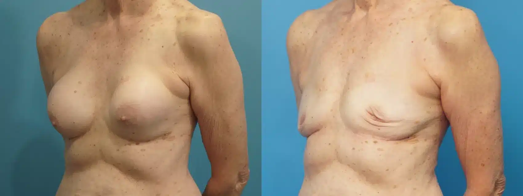 Before and After Image: Breast Implant Removal - left-front-oblique
