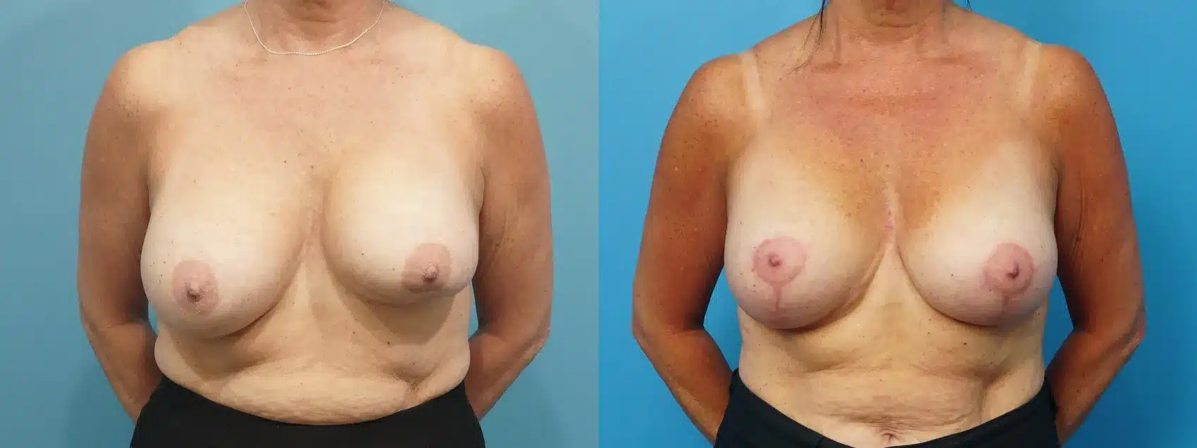 Before and After Image: Revision Breast Augmentation with Lift - front