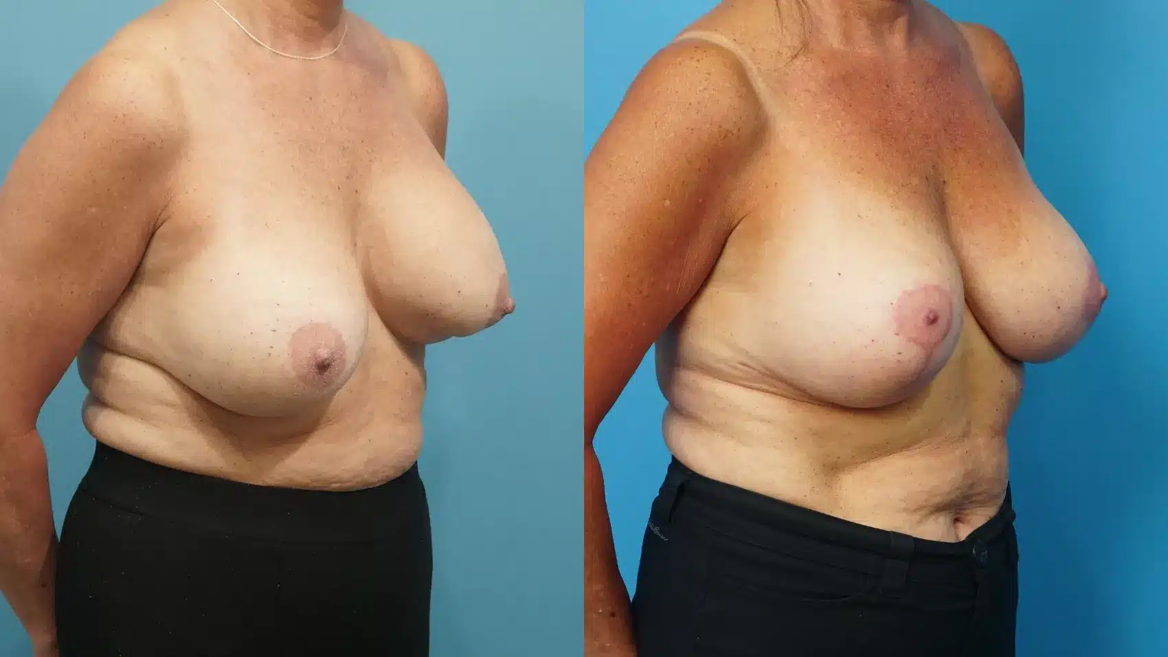 Before and After Image: Revision Breast Augmentation with Lift - right-front-oblique