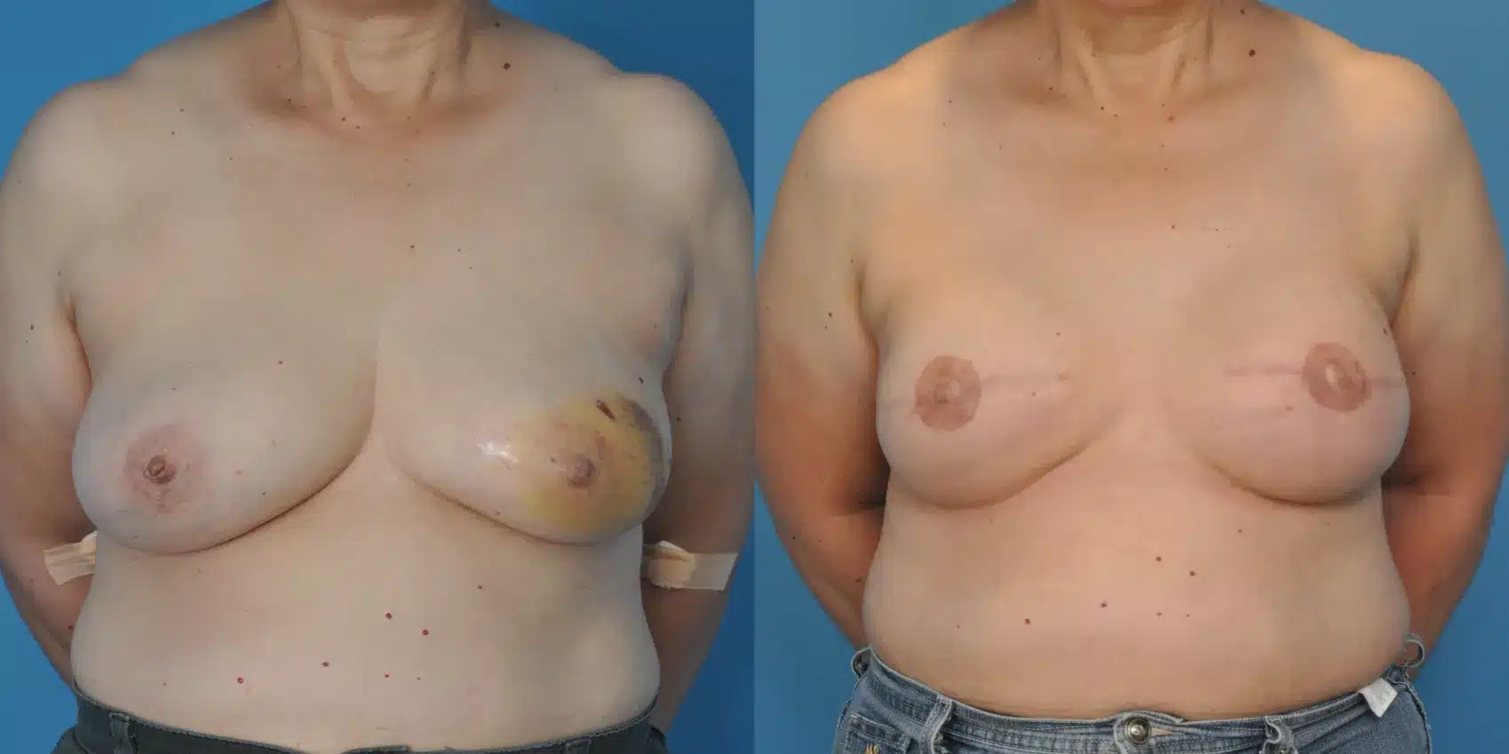 Before and After Image: Case #46 - front