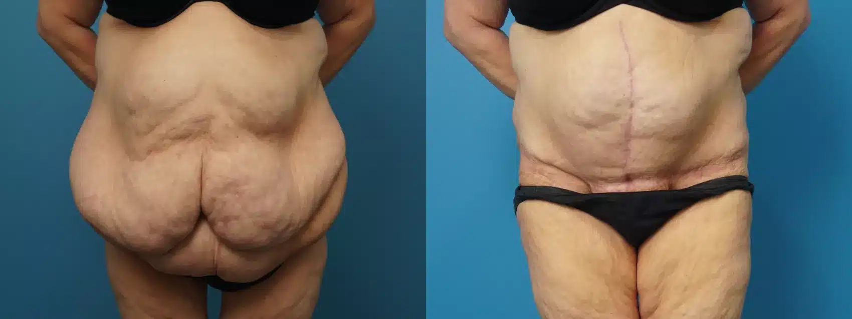 Before and After Image: Case #460 - front