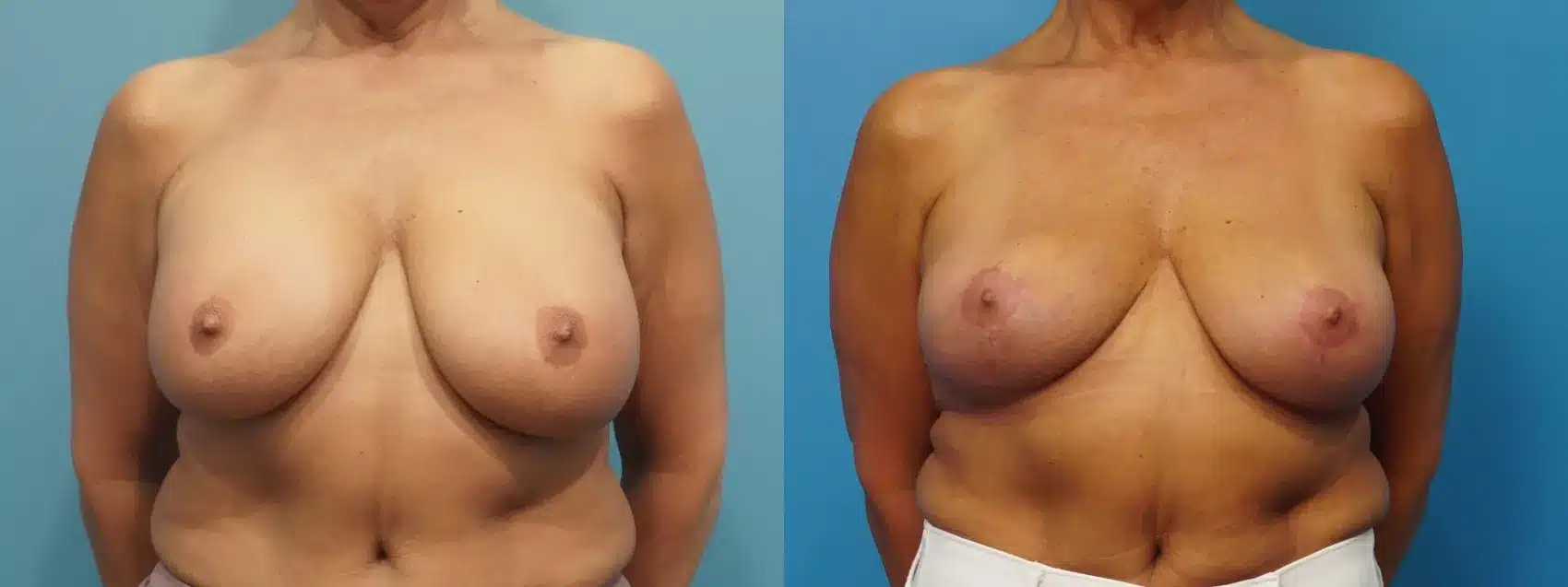 Before and After Image: Breast Implant Removal with Lift - front