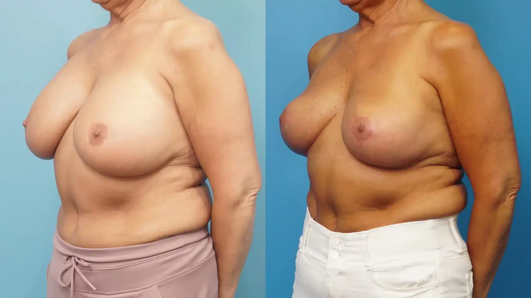 Before and After Image: Breast Implant Removal with Lift - left-front-oblique