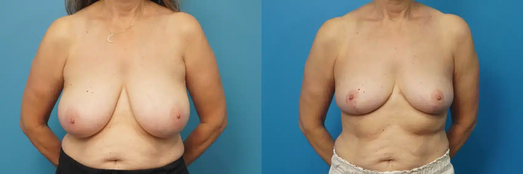 Before and After Image: Case #462 - front