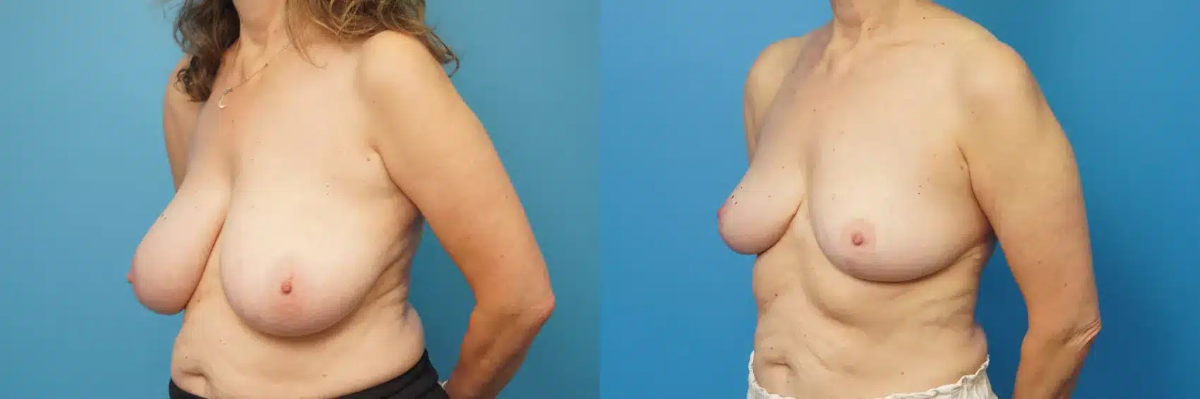 Before and After Image: Case #462 - left-front-oblique