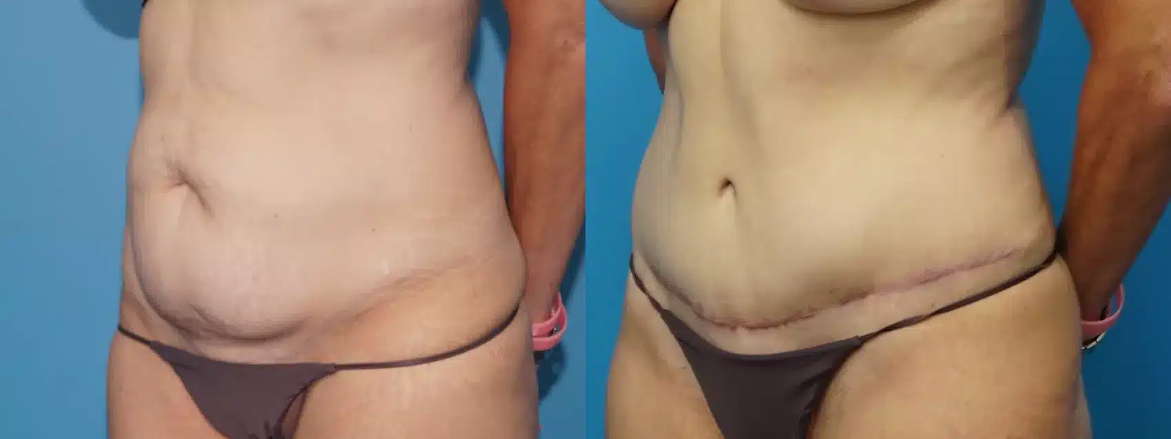 Before and After Image: Case #463 - left-front-oblique