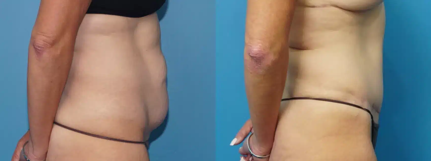 Before and After Image: Case #463 - right-side