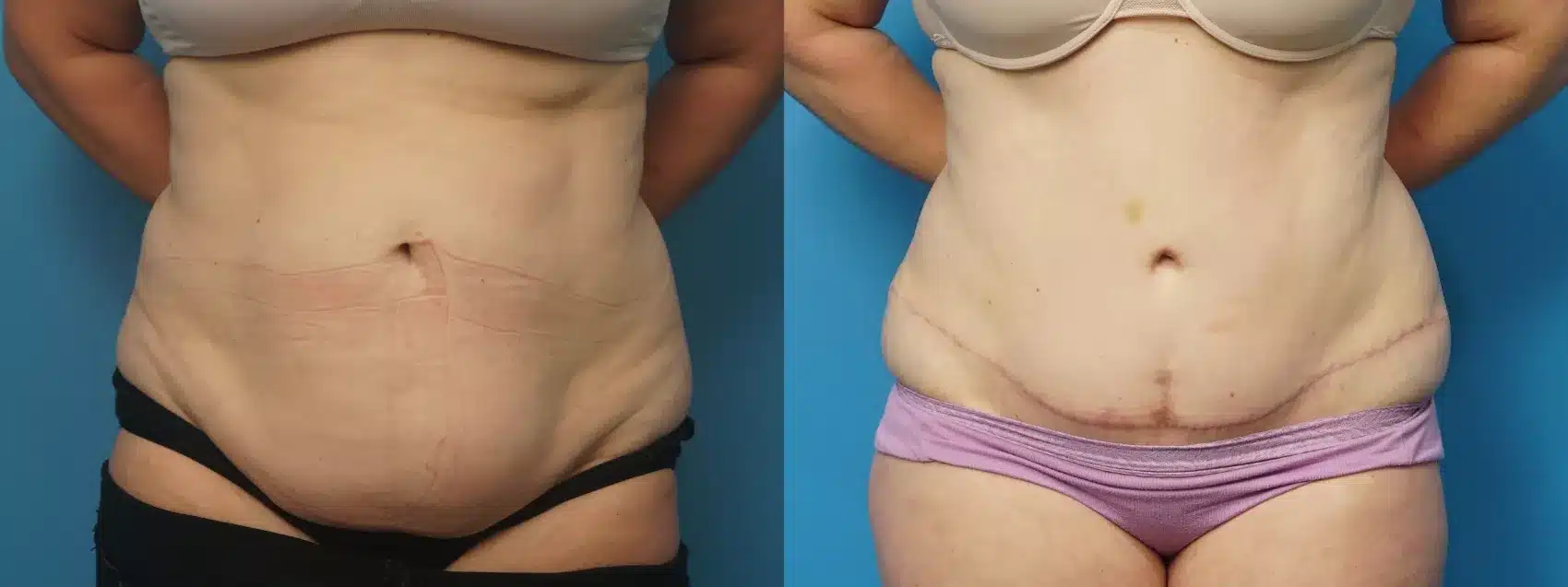 Before and After Image: Case #464 - front