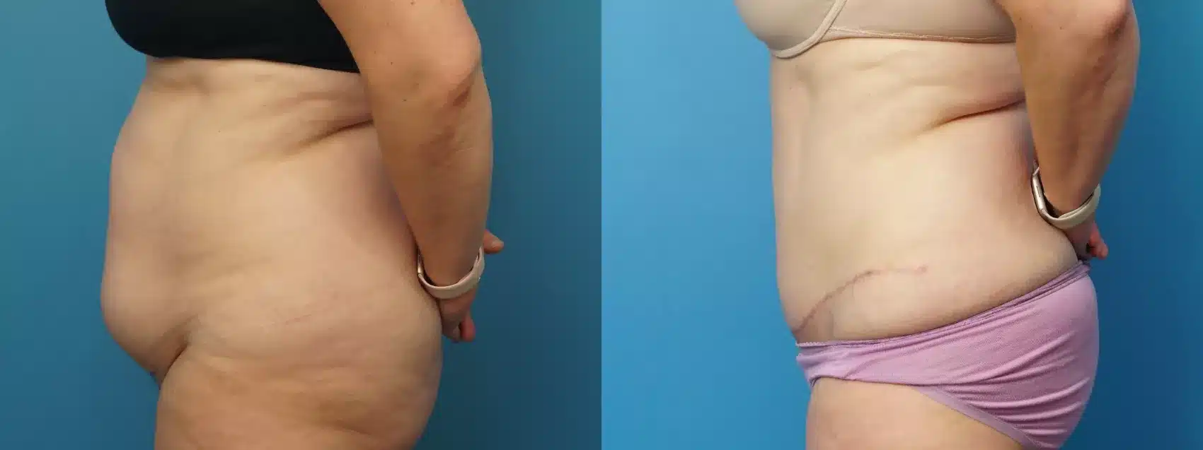 Before and After Image: Case #464 - left-side