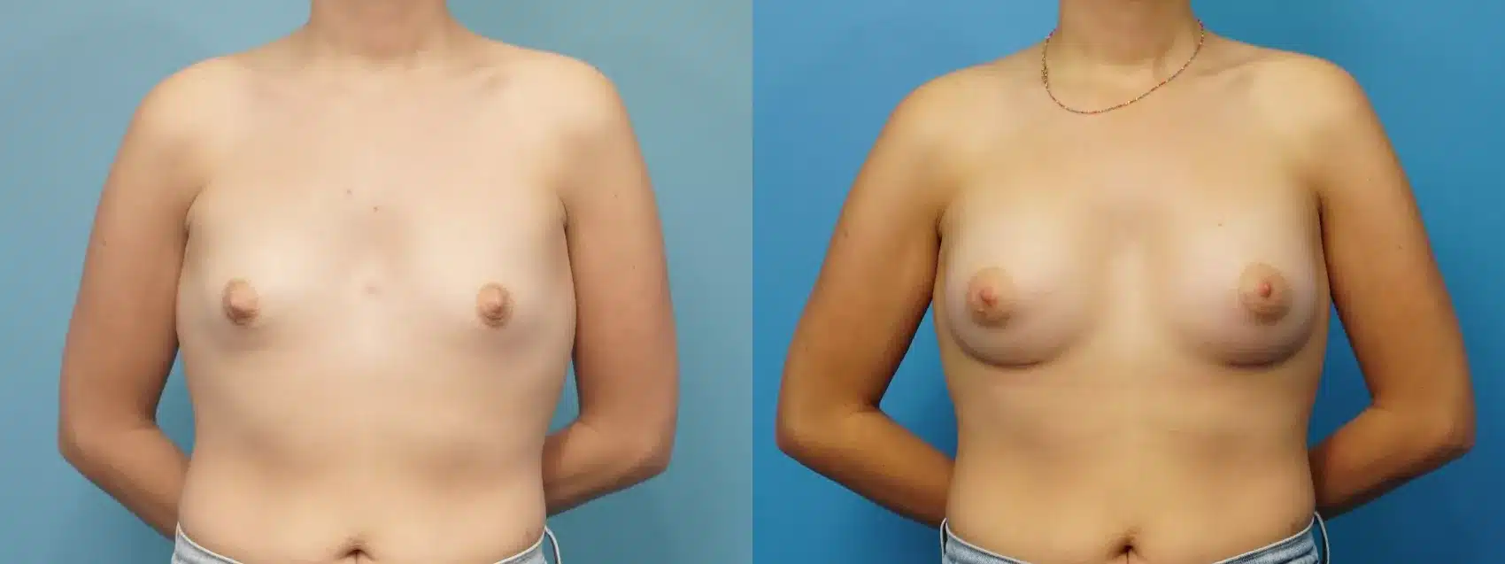 Before and After Image: Breast Augmentation with Silicone Implants - front