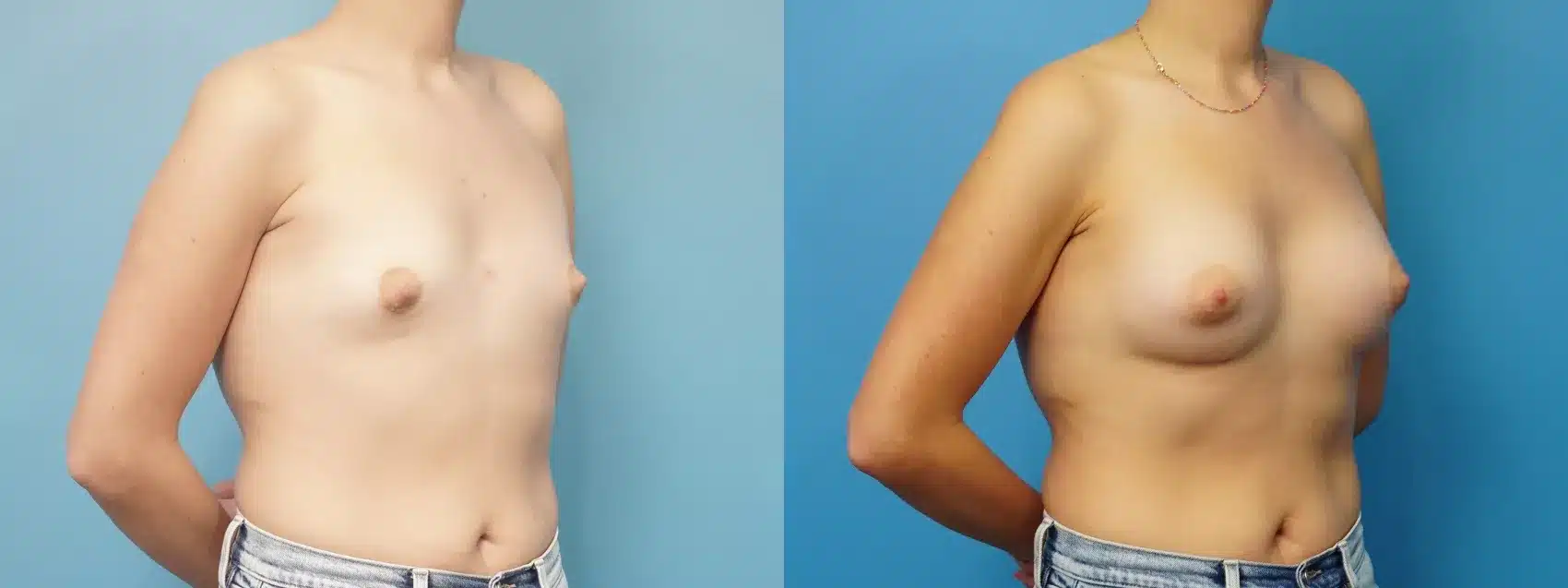 Before and After Image: Breast Augmentation with Silicone Implants - right-front-oblique