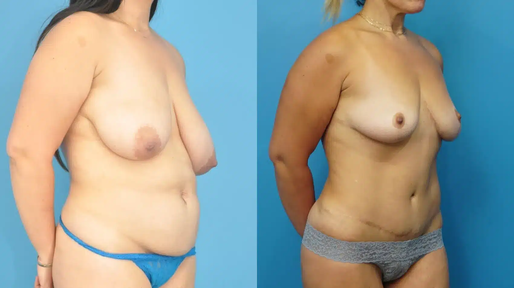 Before and After Image: Breast Lift/Reduction and Tummy Tuck - right-front-oblique