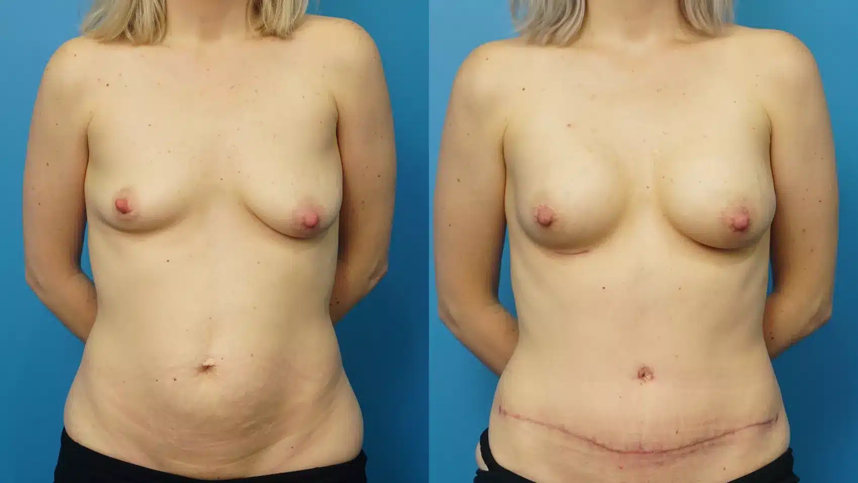 Before and After Image: Breast augmentation and tummy tuck - front