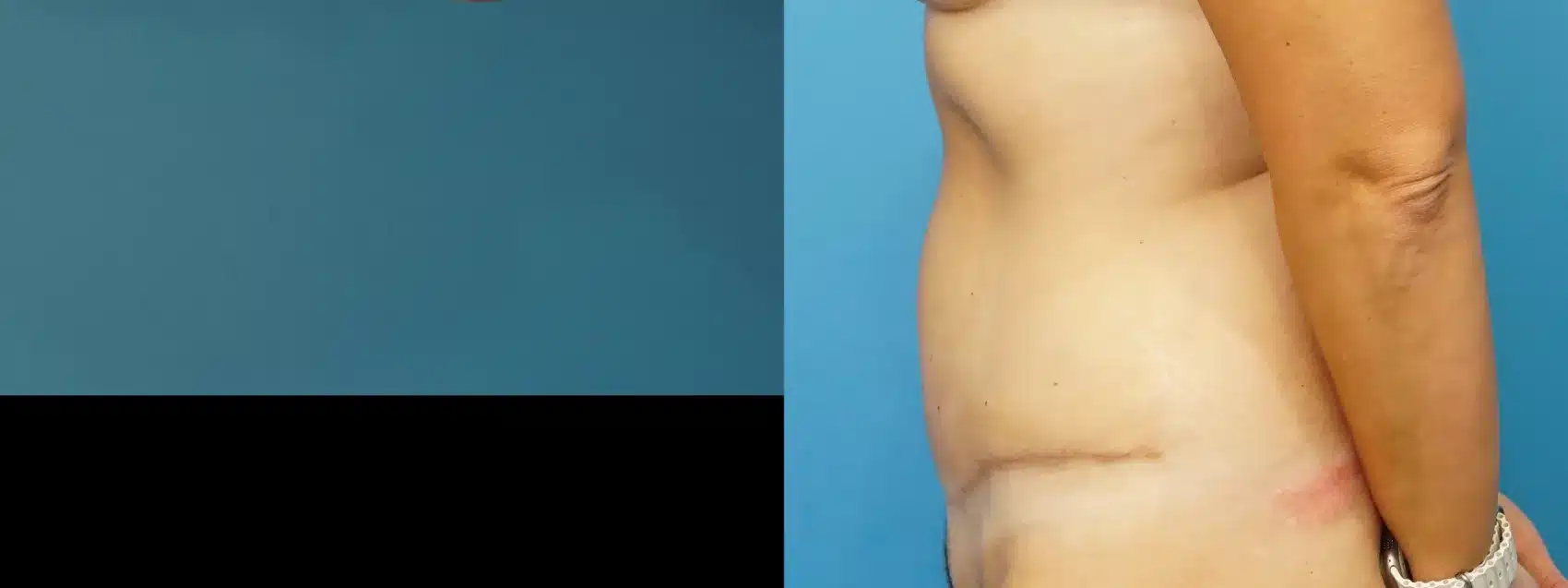 Before and After Image: Tummy Tuck - left-side