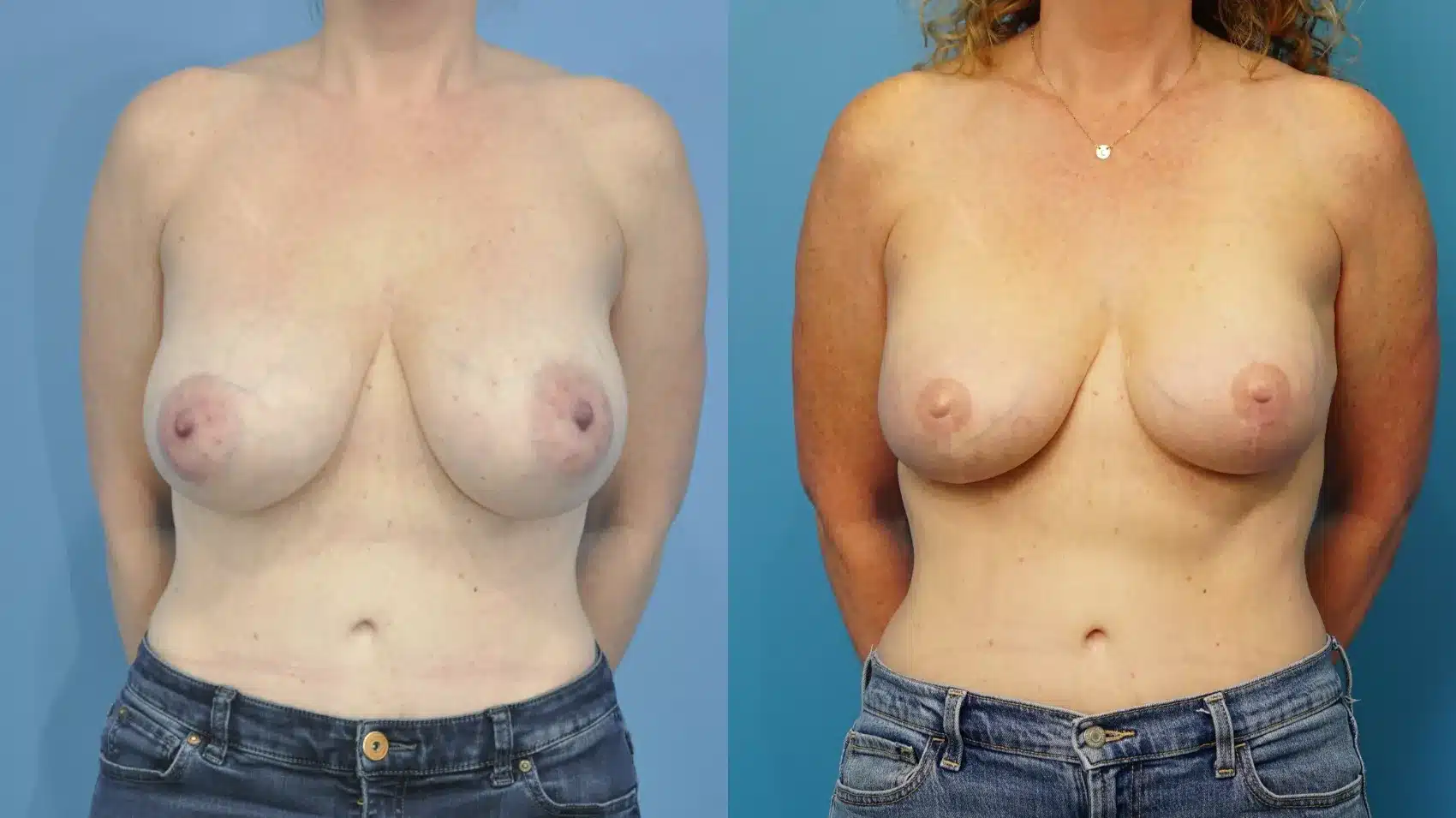 Before and After Image: Skin-Sparing Mastectomy Reconstruction with Implants - front
