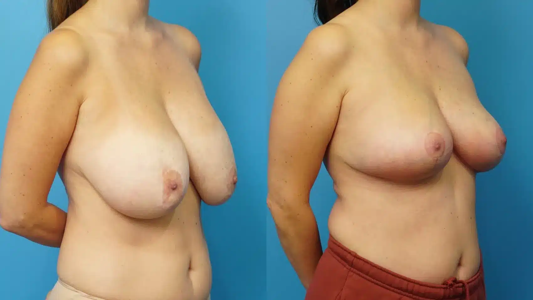 Before and After Image: Breast Implant Removal with Lift - right-front-oblique
