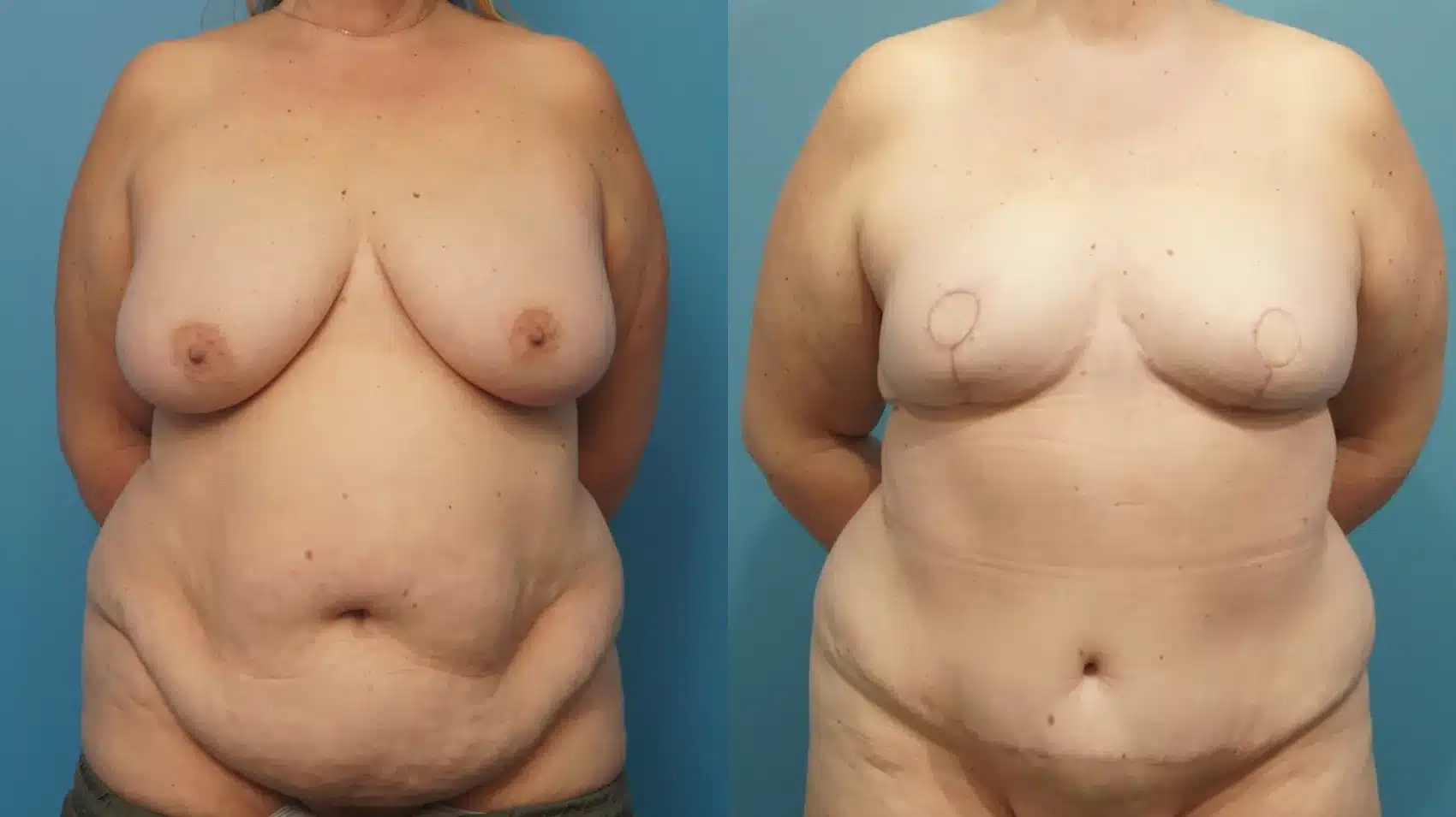 Before and After Image: DIEP Flap Reconstruction - front