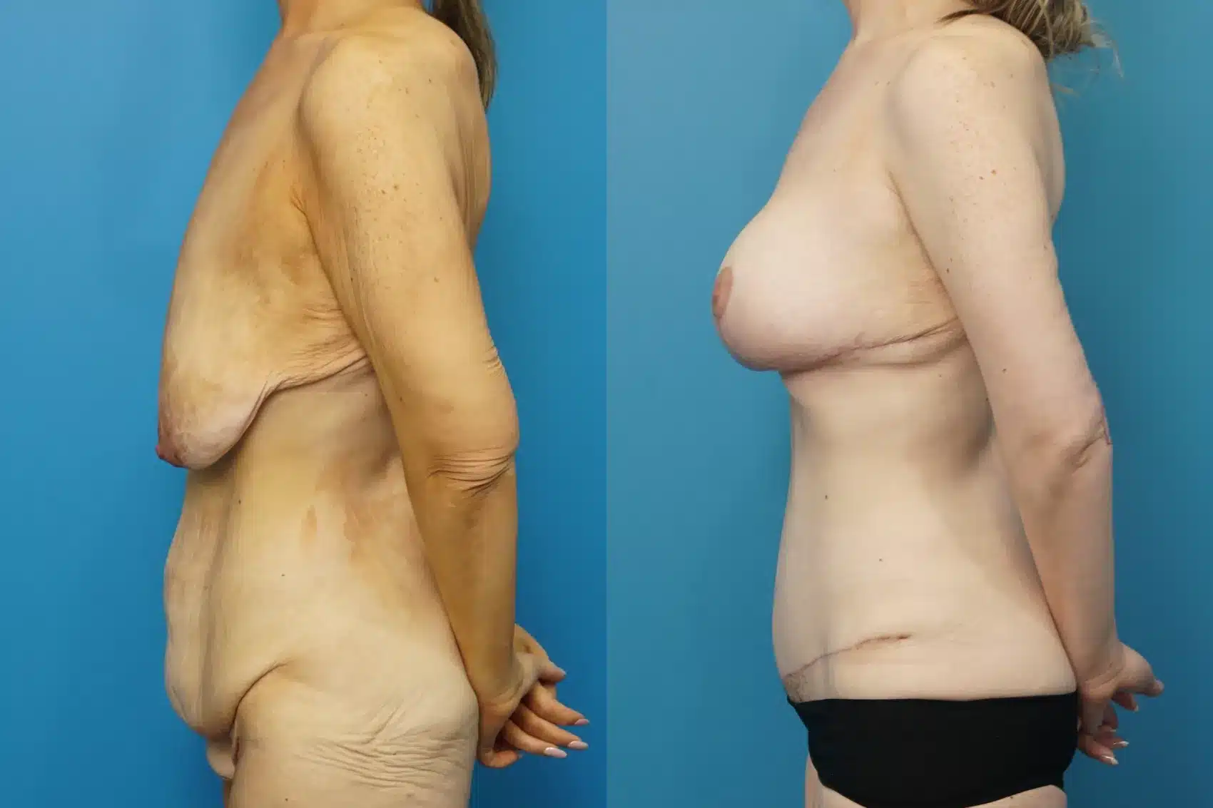 Before and After Image: Breast Lift with Implants, Abdominoplasty - left-side
