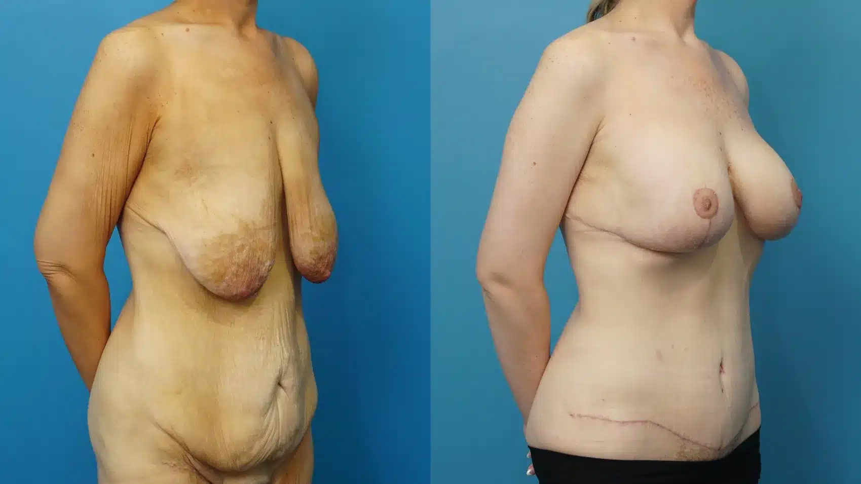 Before and After Image: Breast Lift with Implants, Abdominoplasty - right-front-oblique