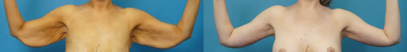 Before and After Image: Arm Lift - front